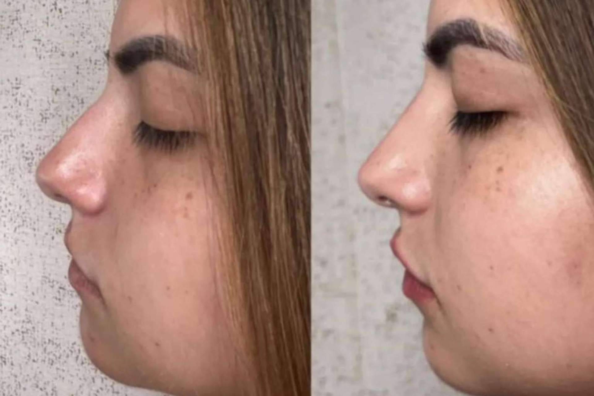 La clínica del Dr. Guidi cuenta con especialistas en rinomodelación en Málaga