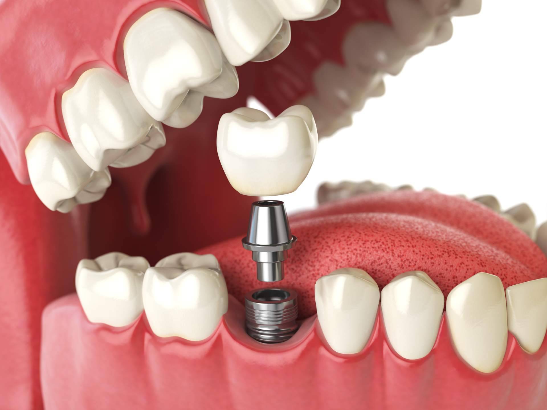 Los beneficios de los implantes dentales, por DeltaDent