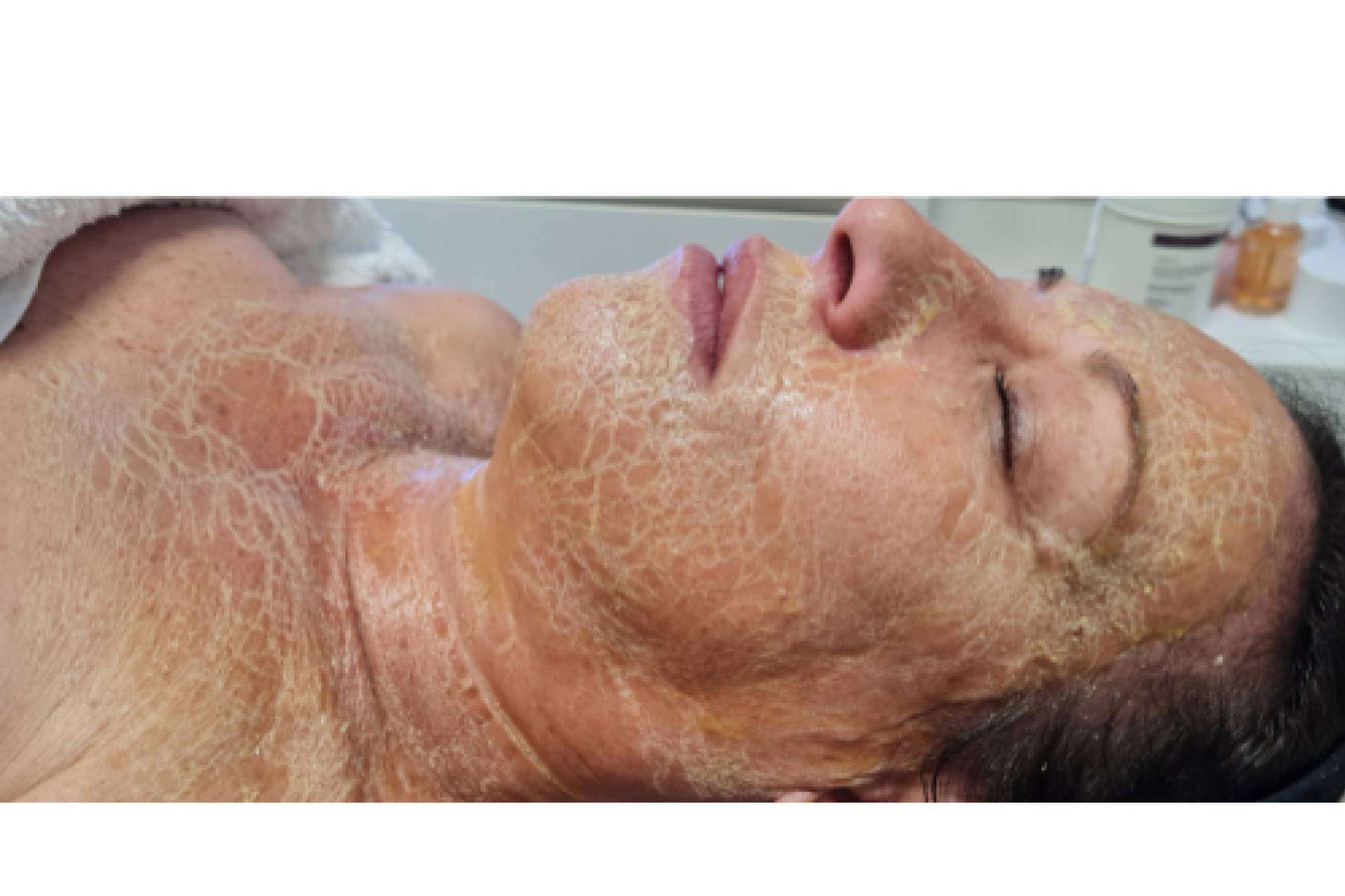 Mascarilla enzimática cosmedique y la revolución en los centros de estética