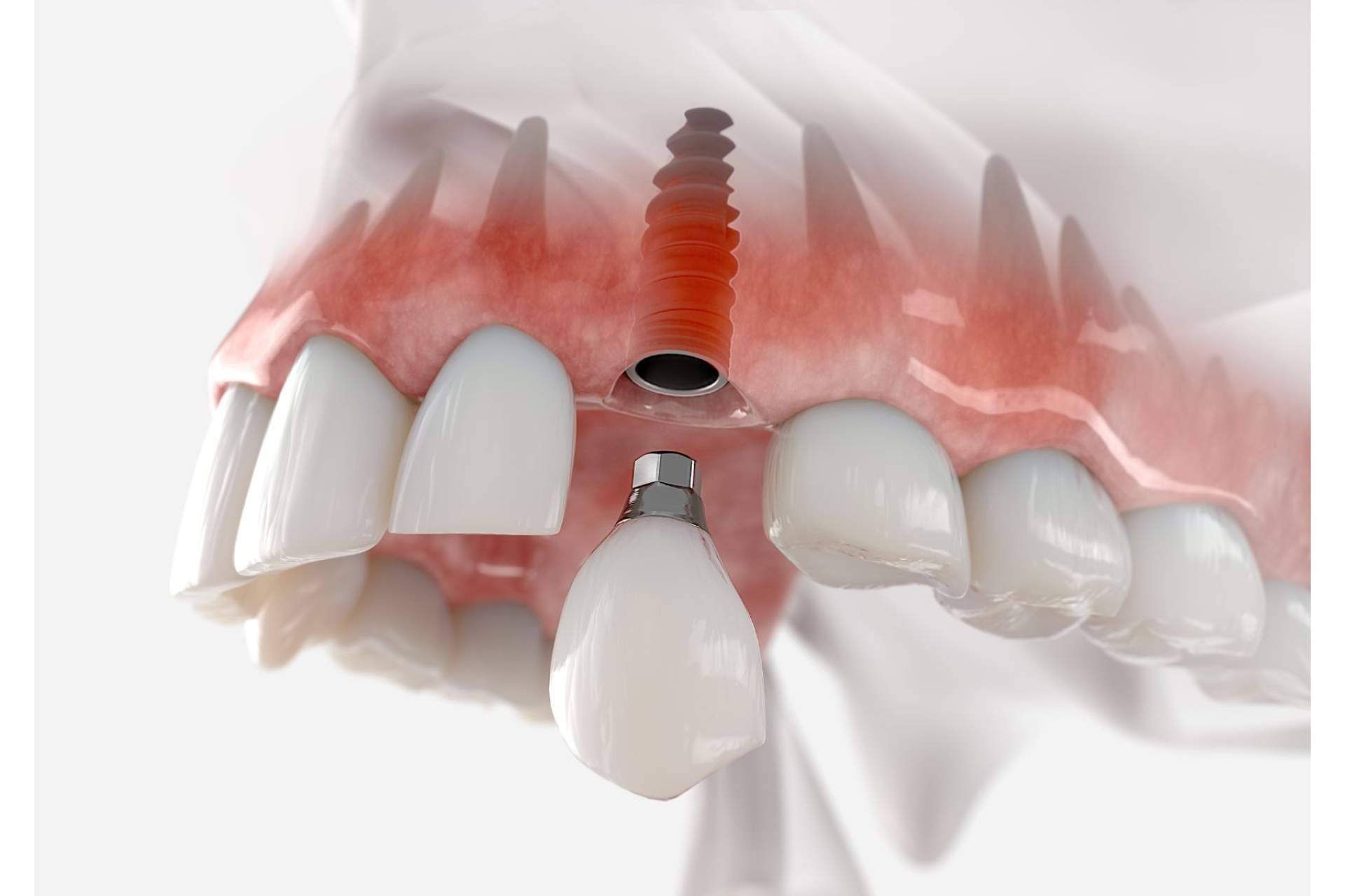Clínica Dental Arai y sus servicios profesionales de implantología dental en Barcelona