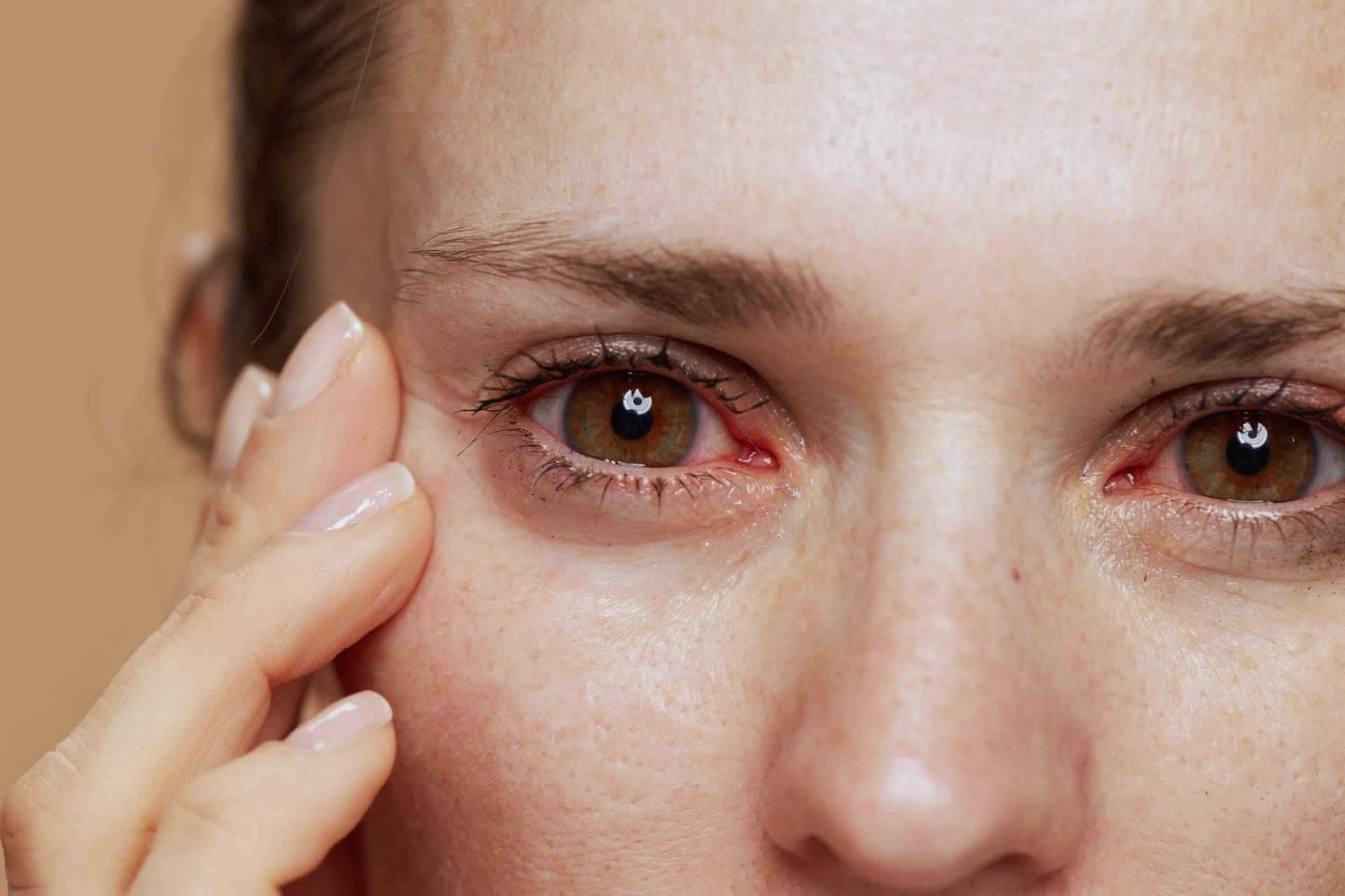 ¿Cuál es la solución perfecta para combatir el ojo seco?