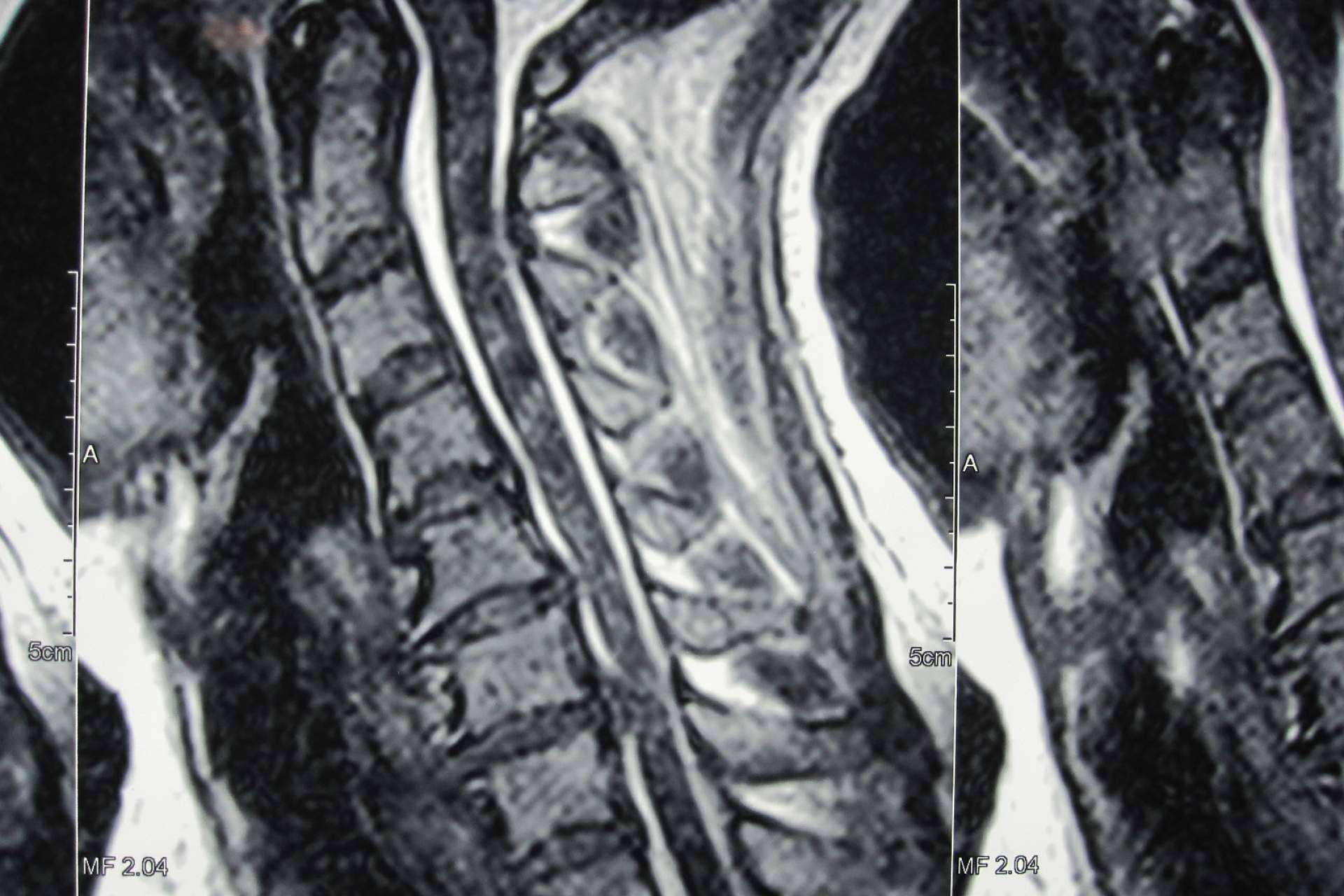 ¿Qué es la hernia disco cervical?, por Neurocirugía Galarza