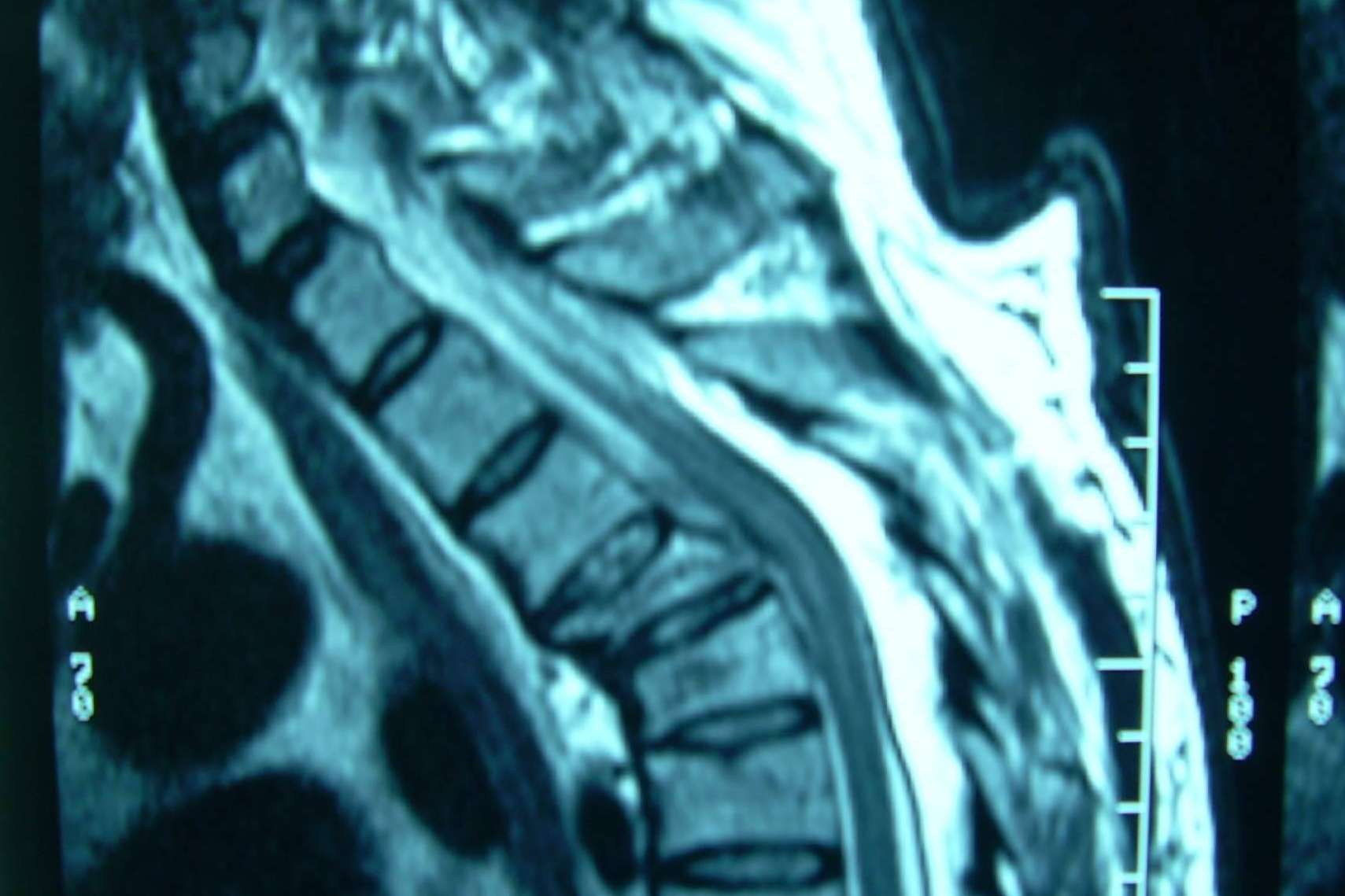 Neurocirugía Galarza informa sobre las fracturas vertebrales