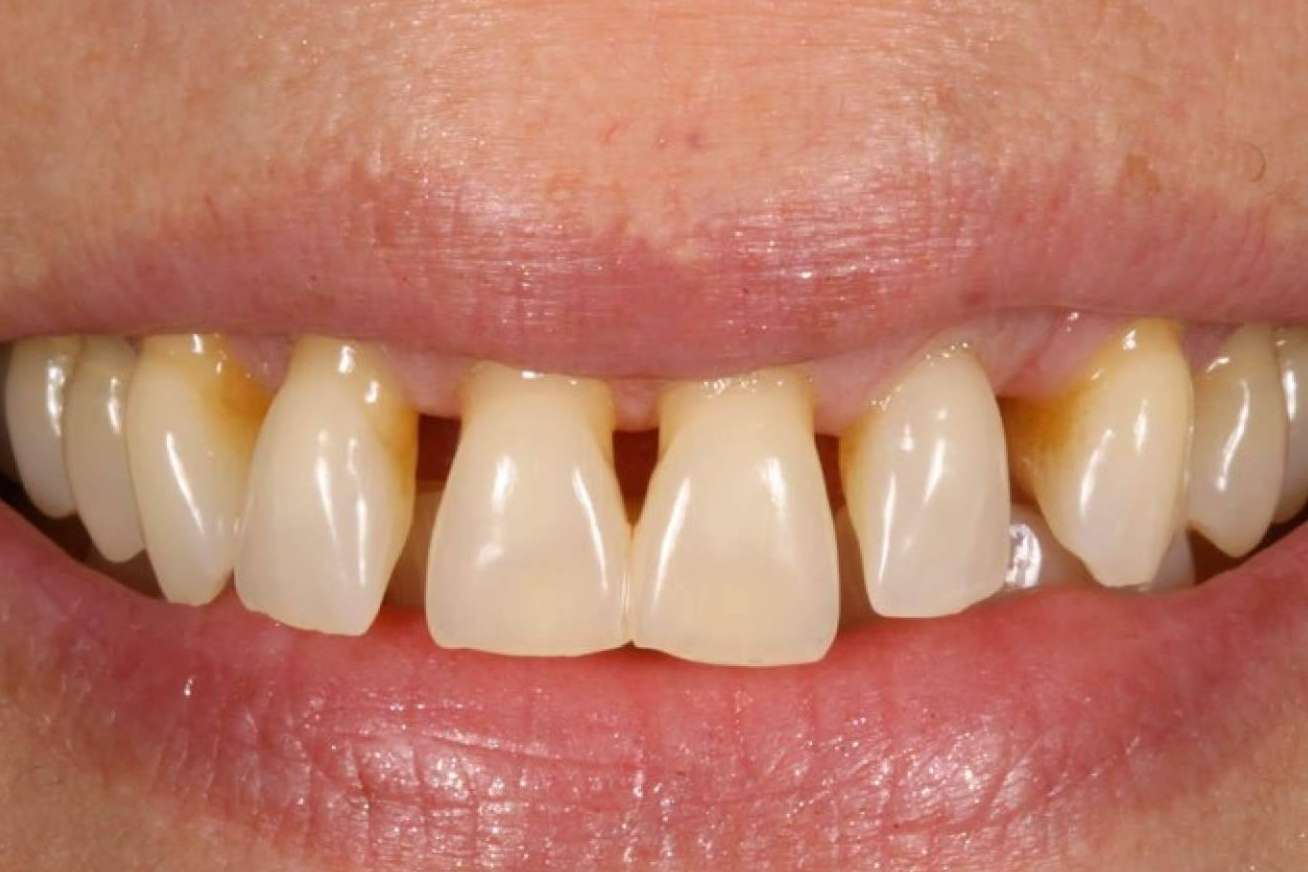 ¿Cómo tratar la gingivitis?, con Clínica Dental Ruiz de Gopegui