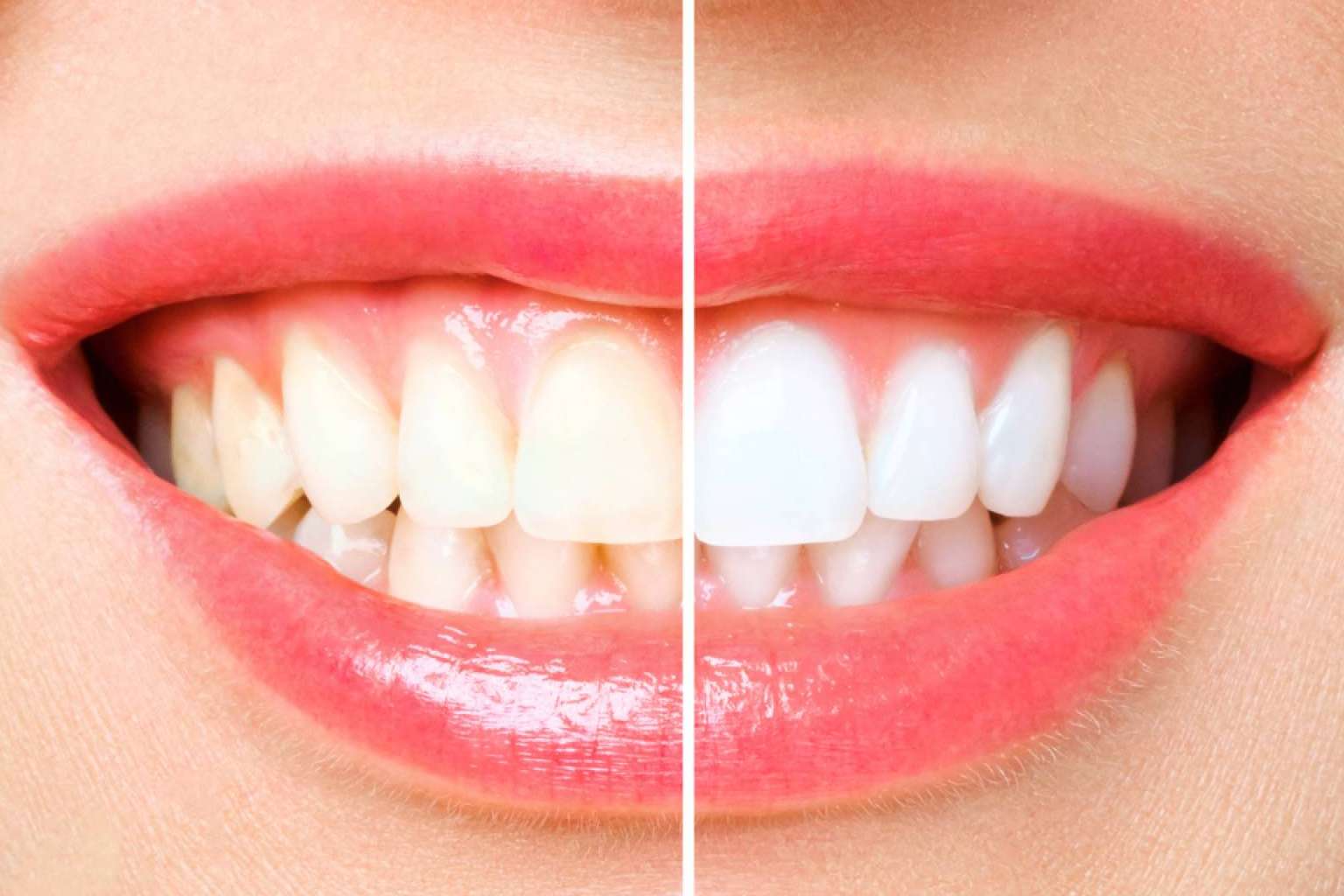 Blanqueamiento dental avanzado con luz LED para conseguir una apariencia radiante