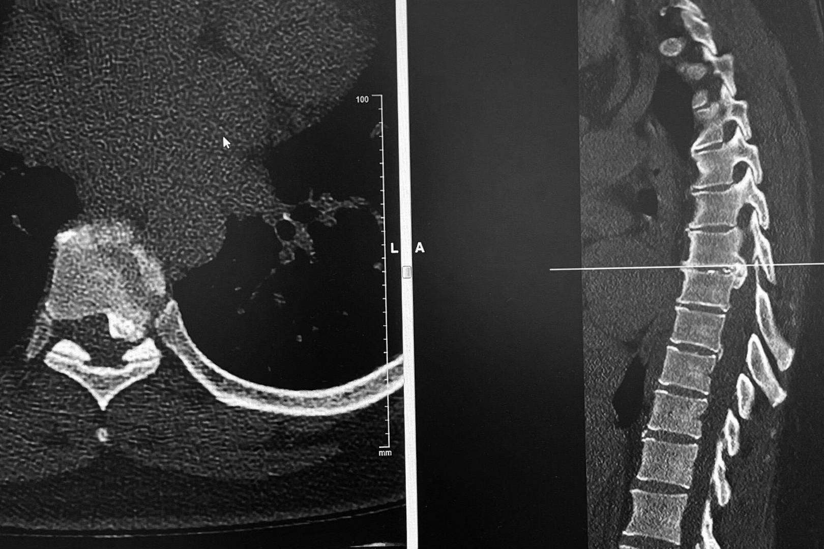 Dr. Carlos Botella-Asunción, neurocirujano especialista en cirugía de hernia discal