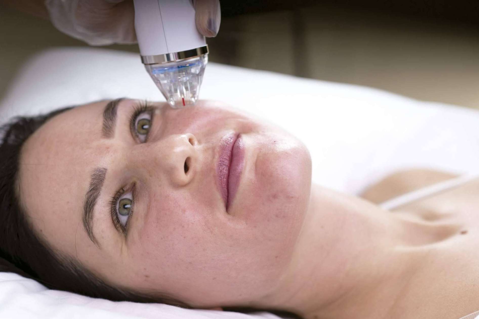 Alluring Clinic y su técnica de resurfacing facial para mejorar la piel del rostro