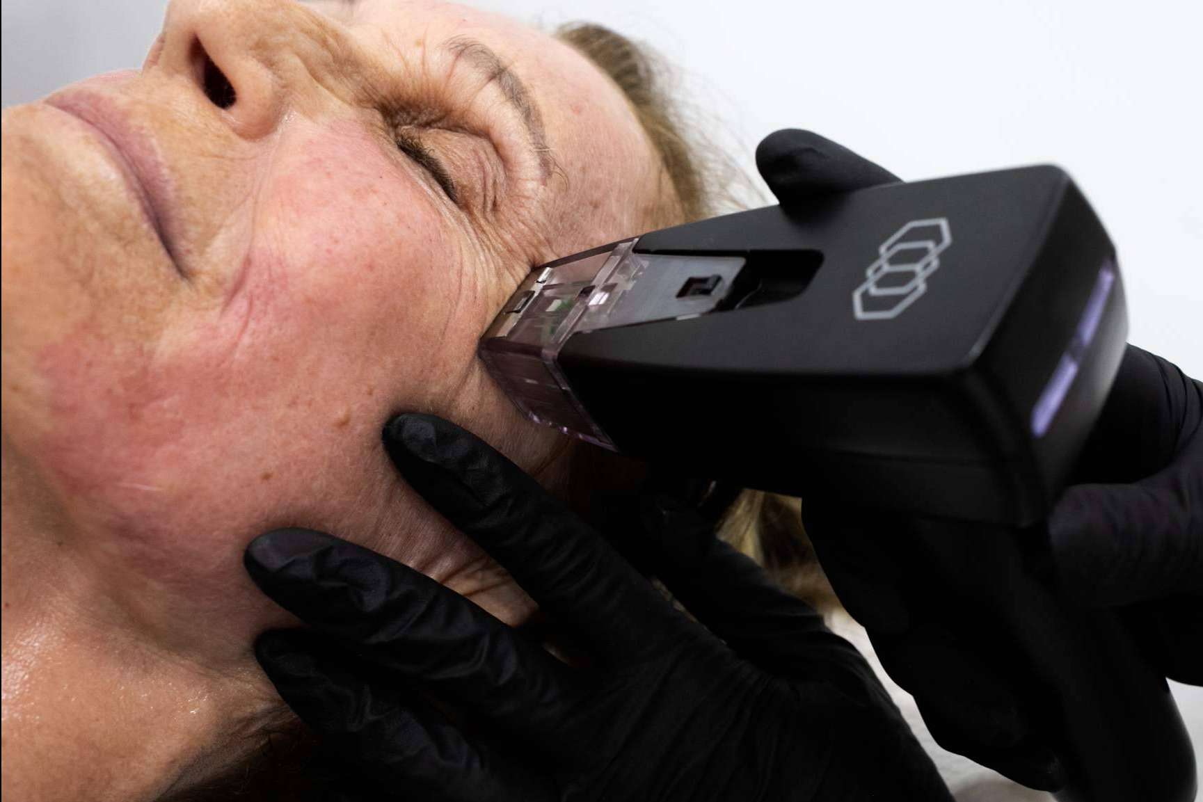 La Clínica BK ofrece un el tratamiento rejuvenecedor Morpheus8 Facial y Corporal