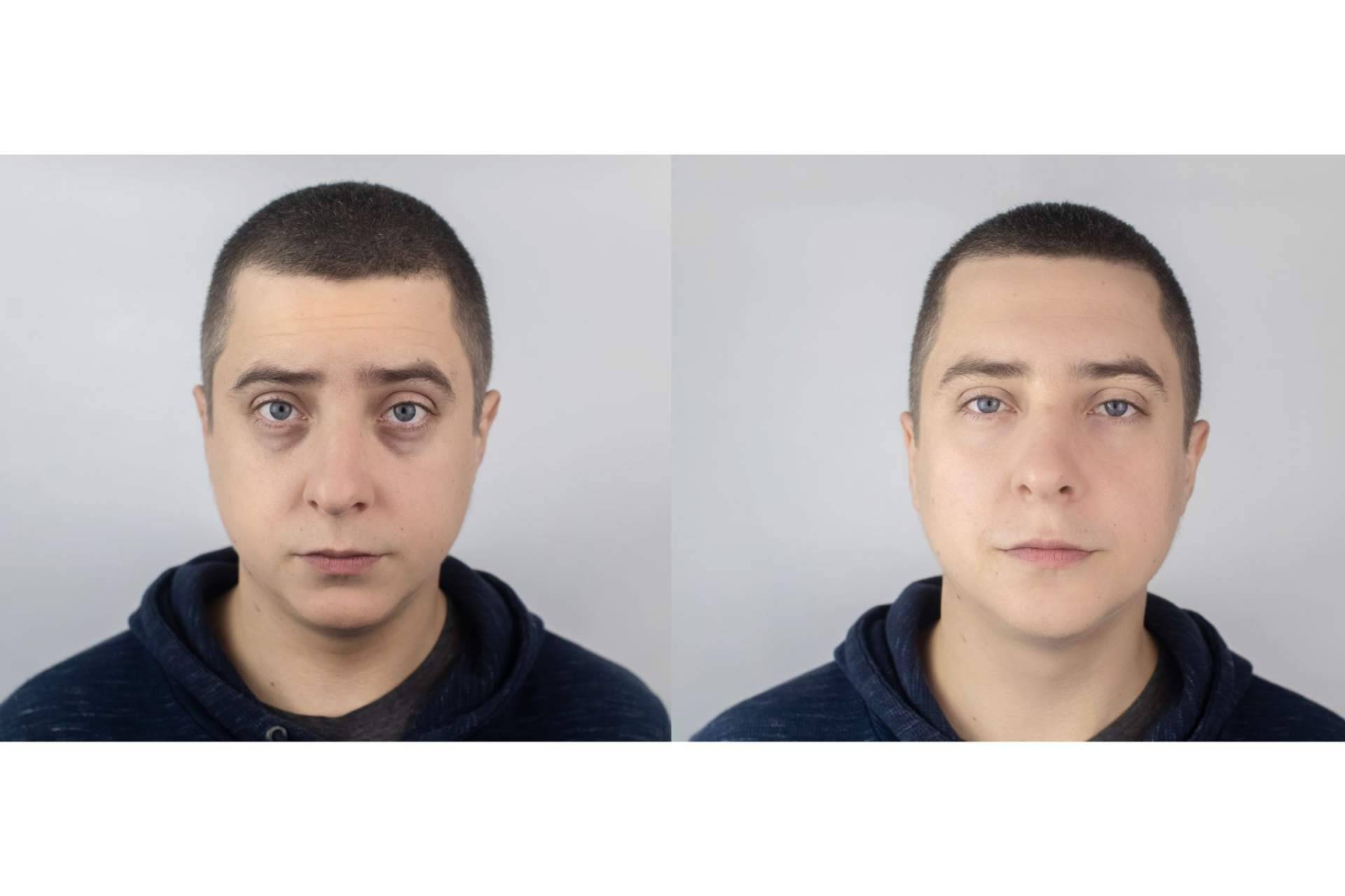 Tratar las ojeras con ácido hialurónico, de la mano de Centro Estética El Pilar