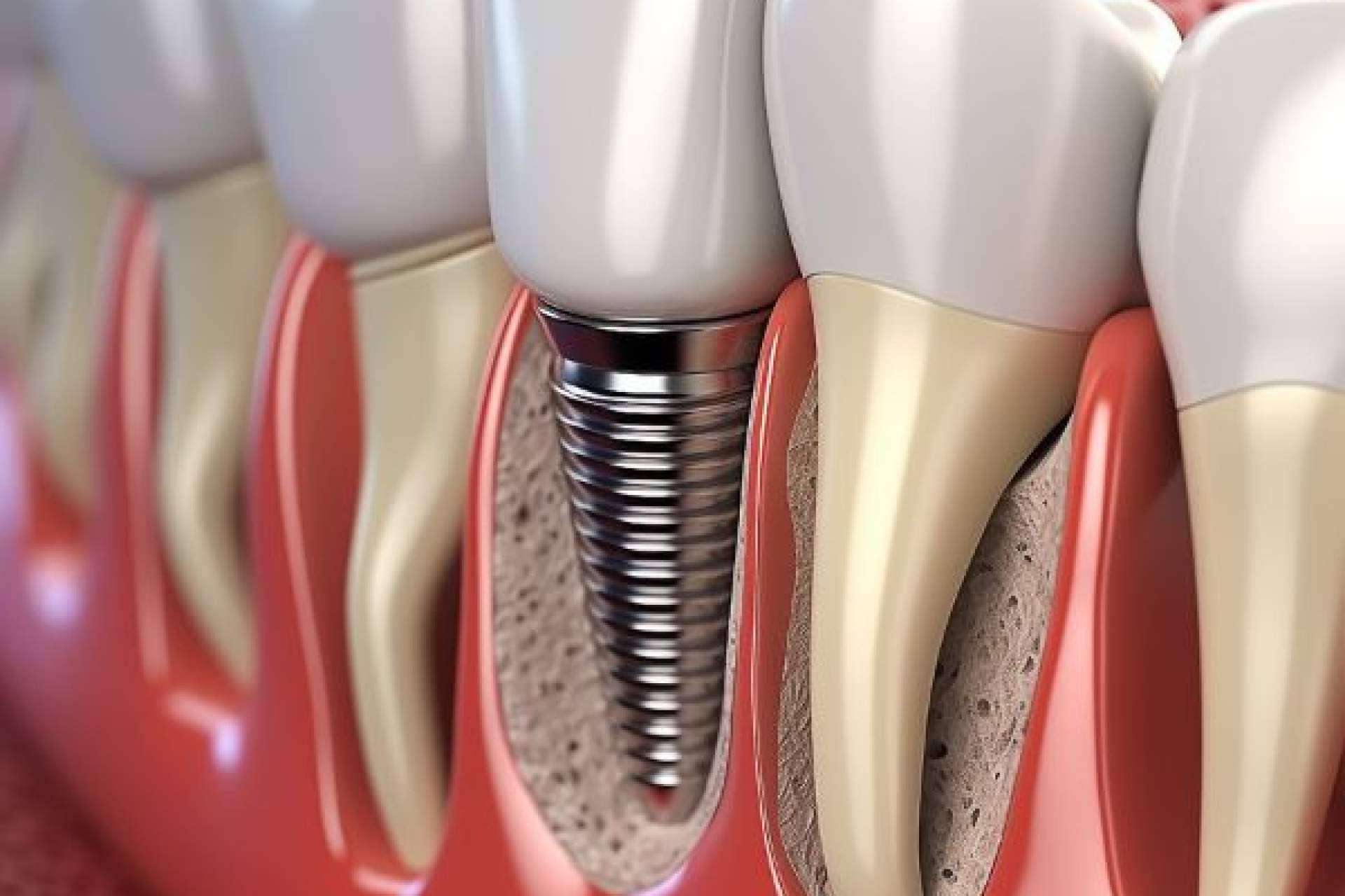 Descubrir el estándar de calidad en implantes dentales de Denty Dent en Madrid