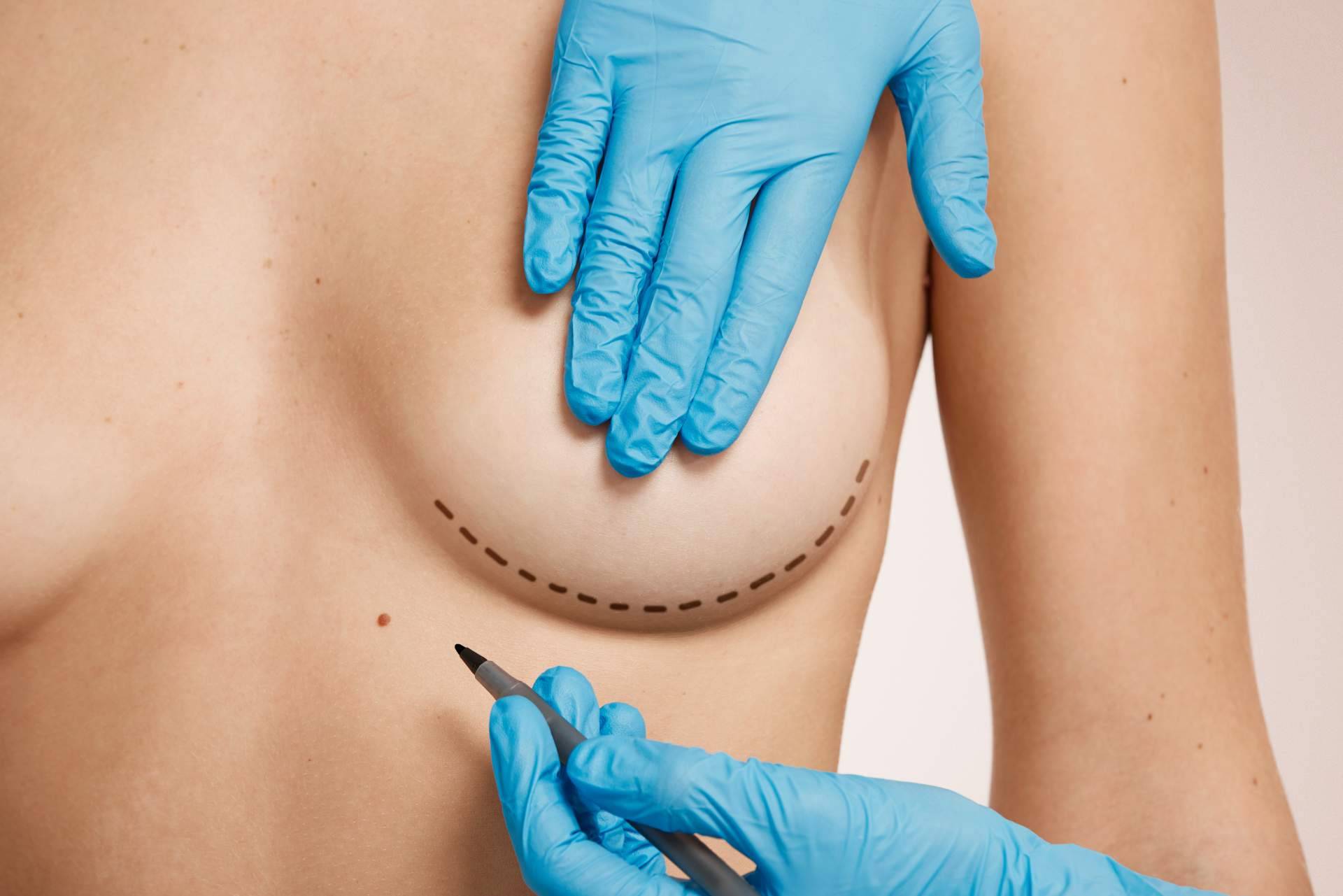 Realizar un recambio de implantes mamarios con los especialistas de la clínica de cirugía plástica Beauty&Beauty