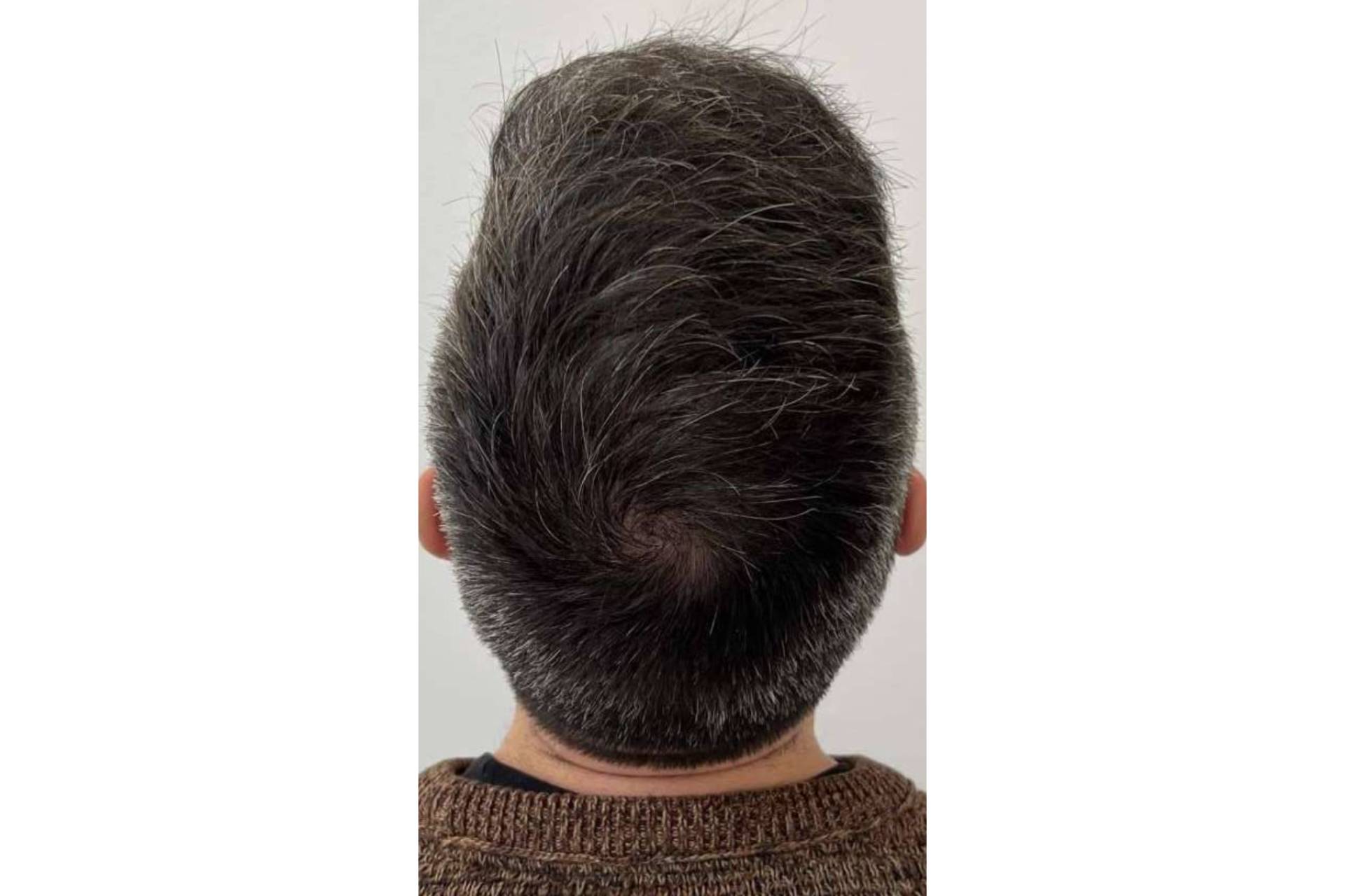 El Dr. Chara, un especialista en injerto capilar en Barcelona  y otros tratamientos para la alopecia