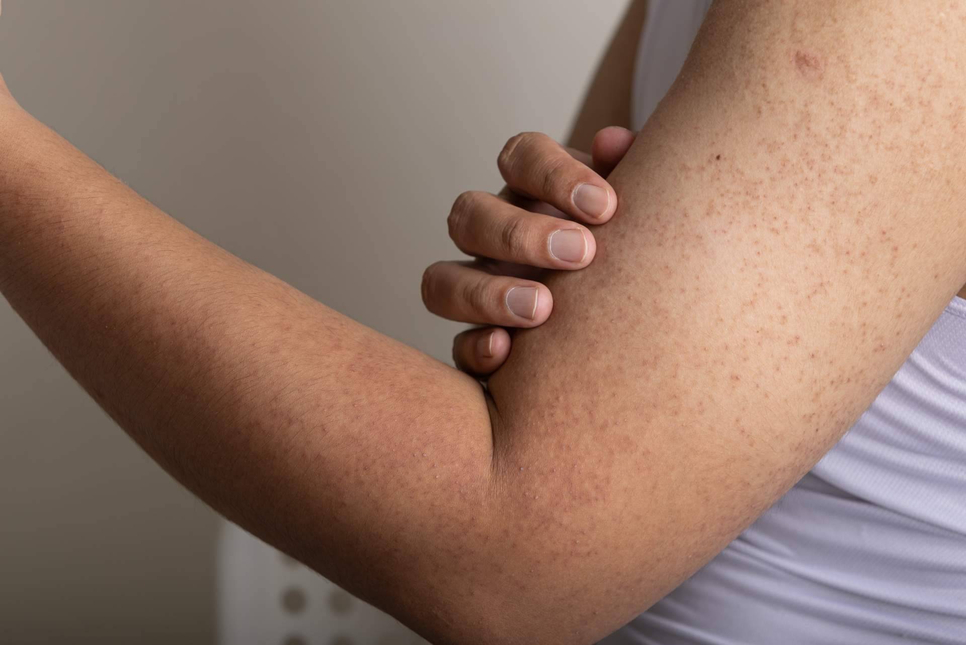 La Dra. Janeth Arévalo sugiere algunos tips para aliviar los síntomas de la queratosis pilaris