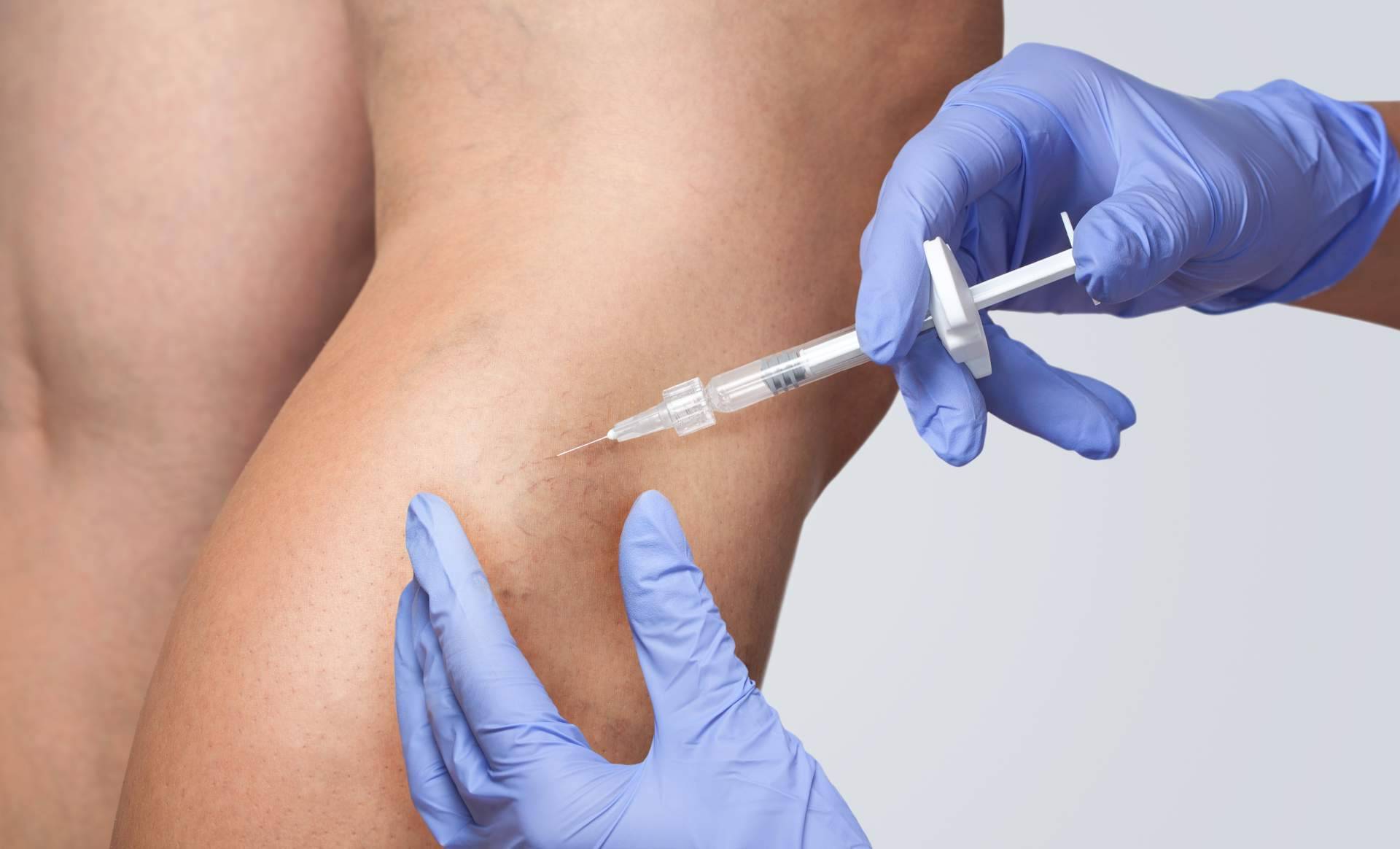 Centro especializado en eliminación de varices en Madrid