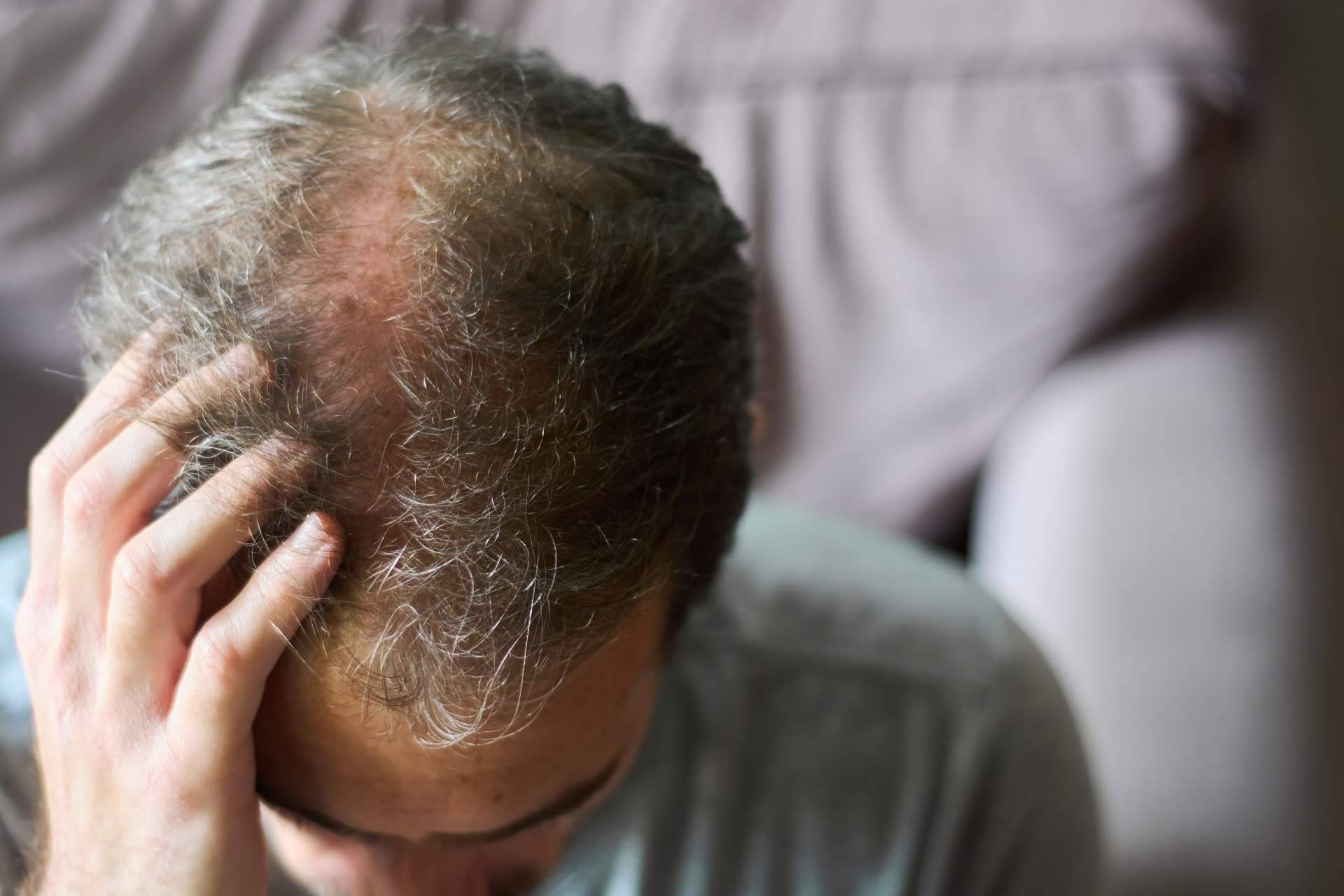 El Institut Mèdic DaVinci precisa los efectos de la alopecia androgénica en hombres y mujeres