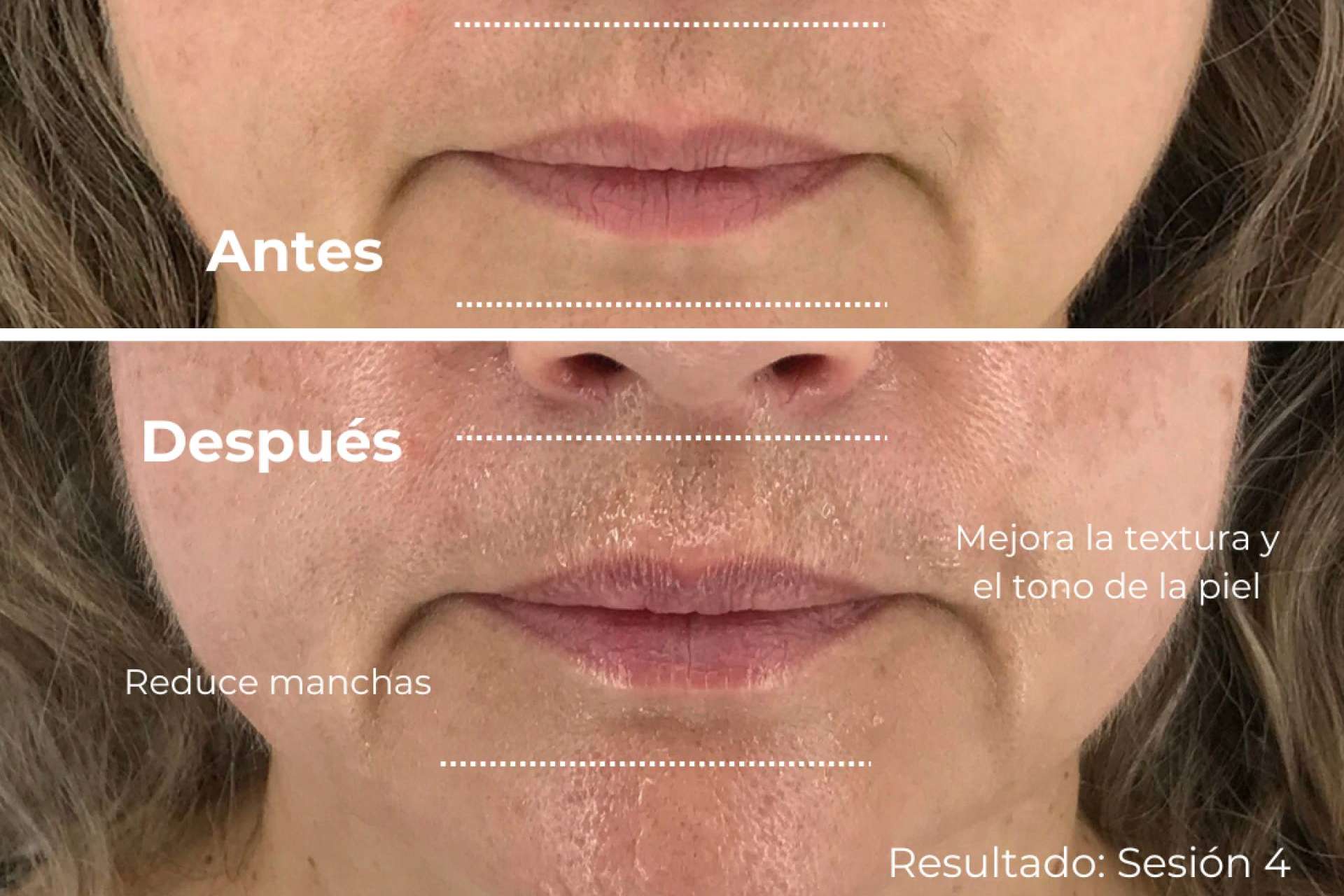 Lifting 4D, el nuevo estándar mundial para un rejuvenecimiento sin inyecciones y duradero