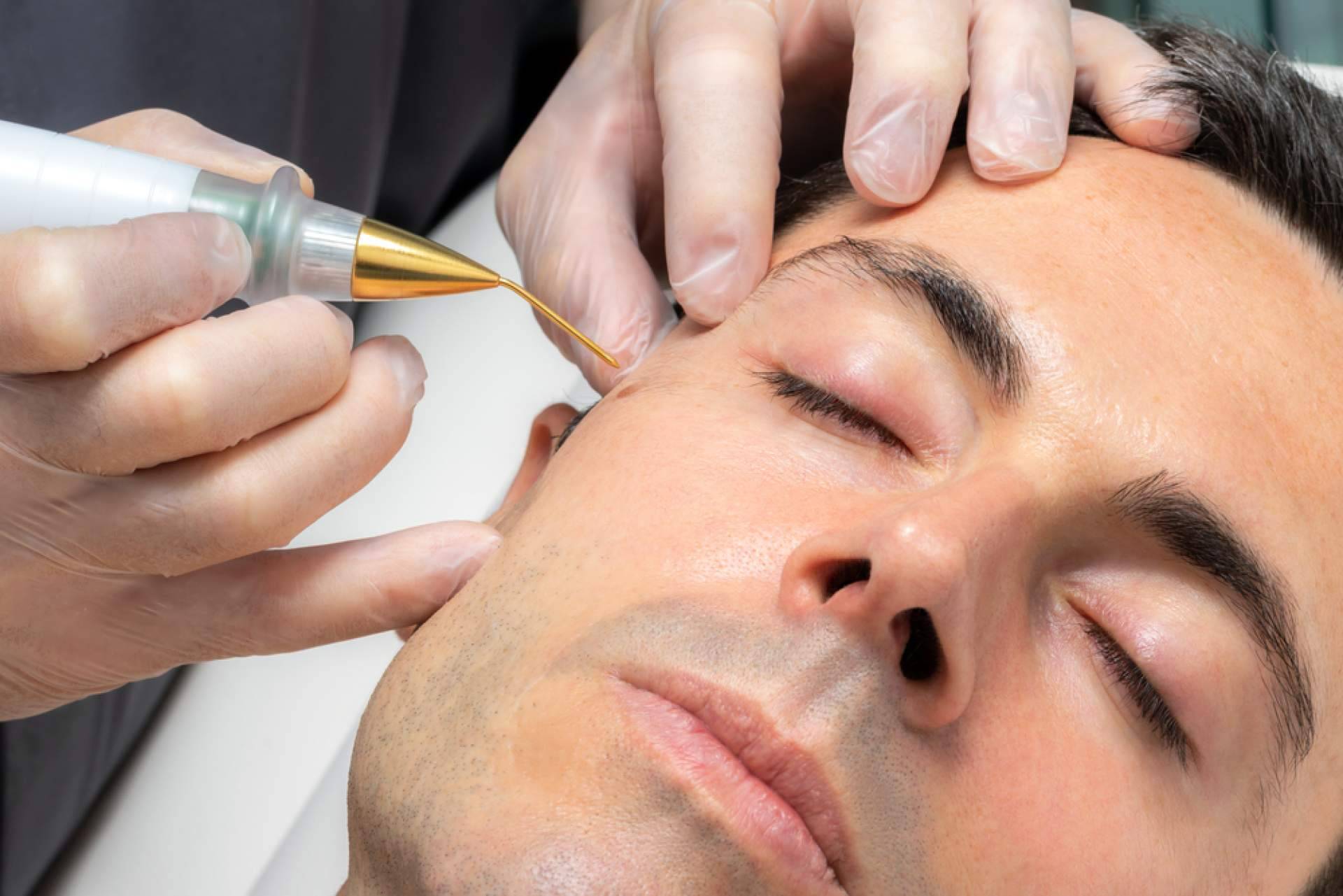 Eliminar lunares y verrugas de forma personalizada y sin marcas, la propuesta del Centro Estética El Pilar