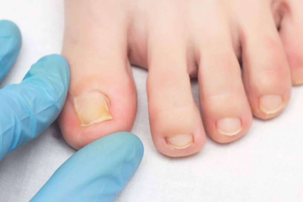 Mycogel de Laboratoires Bailleul, solución eficaz contra hongos y micosis en el pie de atleta