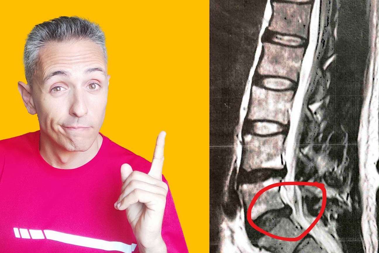Roberto Galván explica cuál es el enfoque más eficaz para el tratamiento de la hernia discal L5-S1