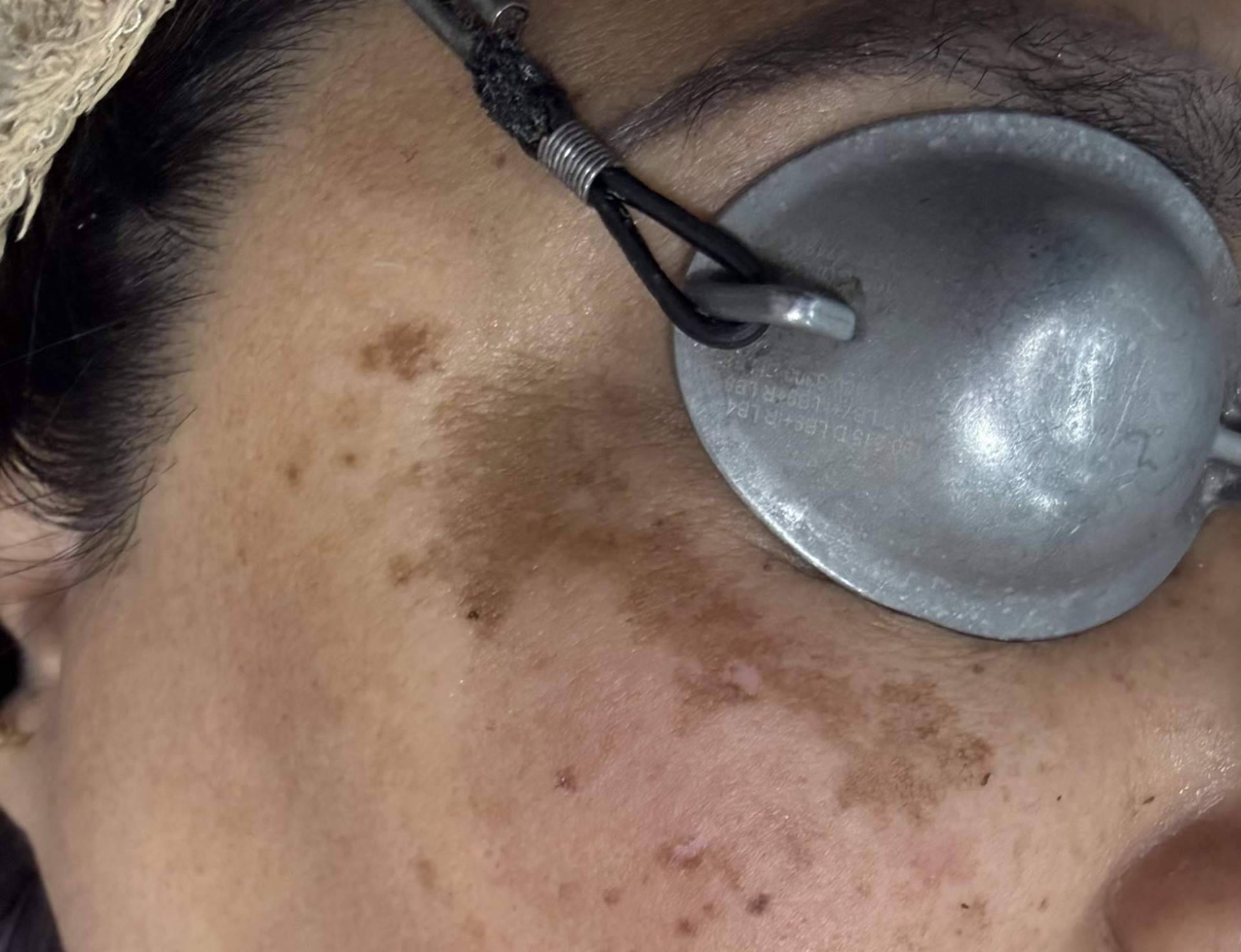 Melasma, factores de riesgo y hábitos alimentarios que pueden empeorar su aparición, según la Dra. Janeth Arévalo