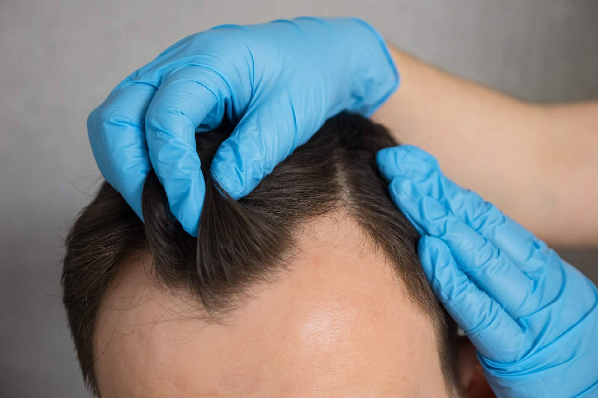 Dr. Jesús Aníbal Mora, especialista en trasplante capilar con enfoque personalizado y resultados naturales
