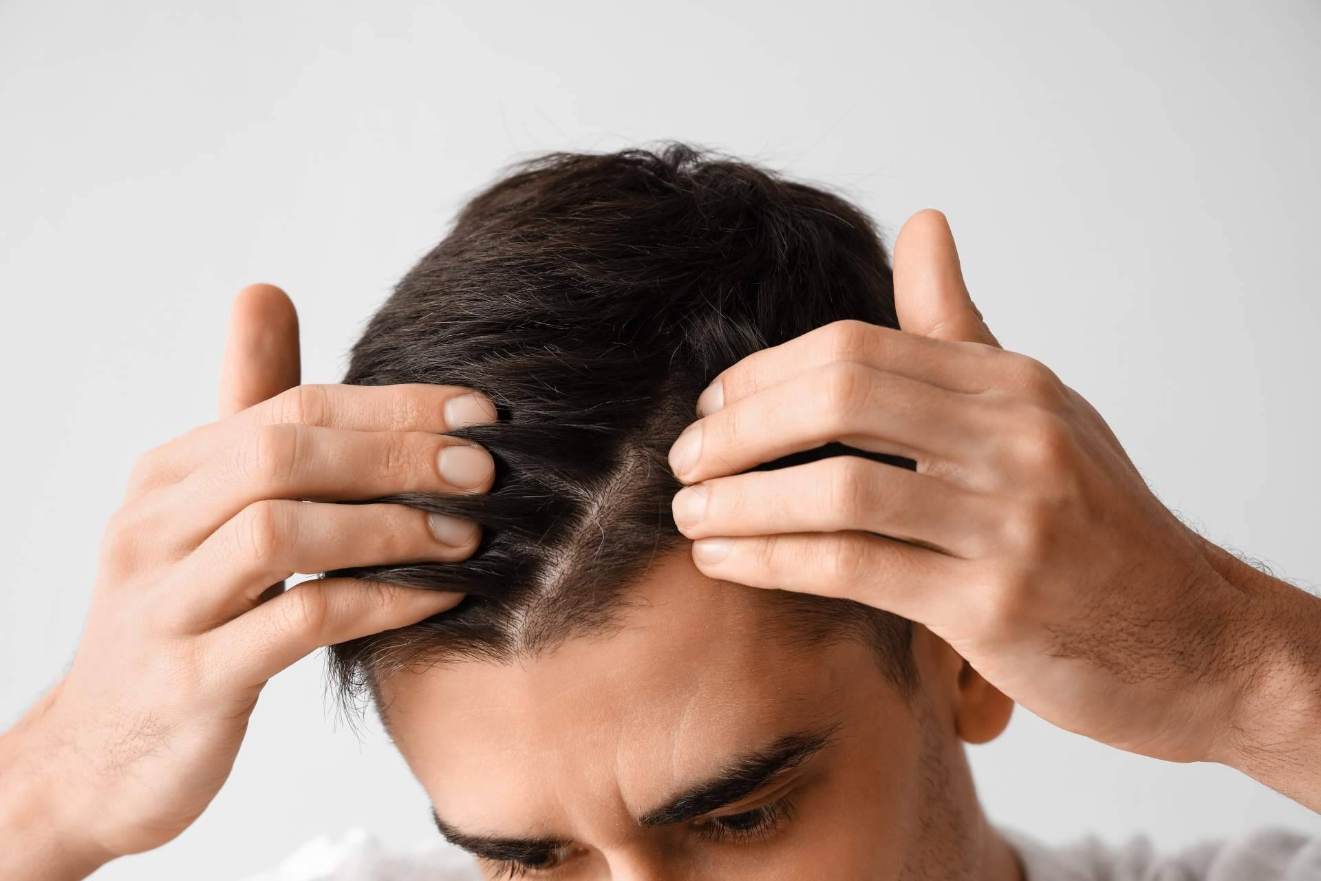 Xpecia Hombre, el aliado nutricional contra la alopecia androgénica disponible en HairFluencer