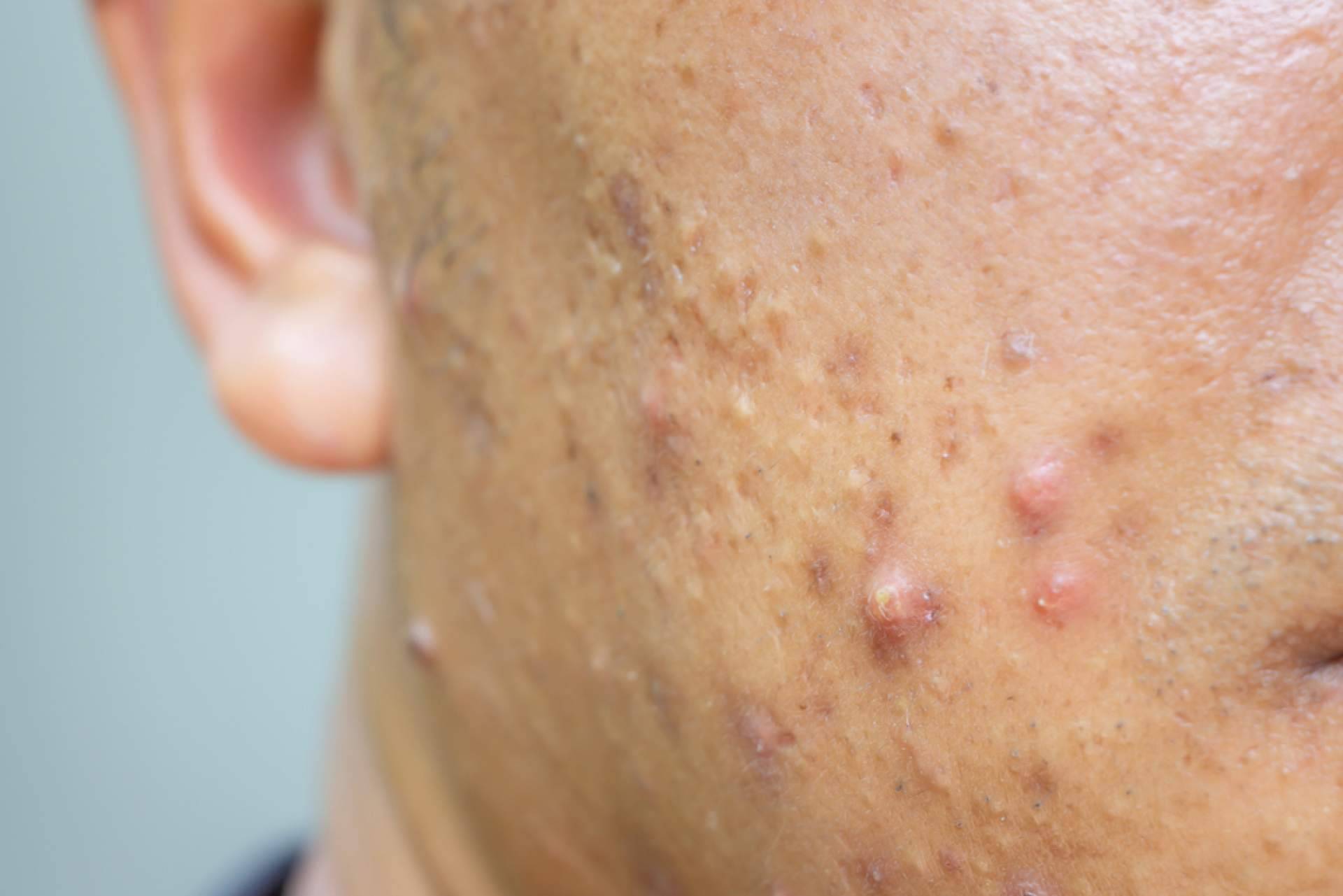 Claves para tratar el acné sin irritar la piel en los meses de otoño